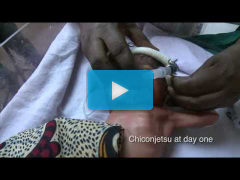 Rice students develop life-saving infant breathing machine